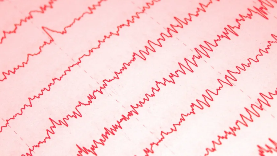 Alzheimer's Specifically Destroys Deep Sleep, Not Dream Sleep